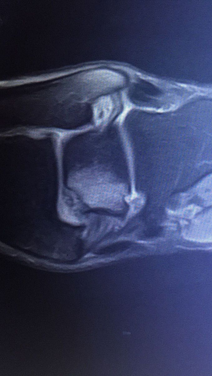 Osteochondrale Läsion