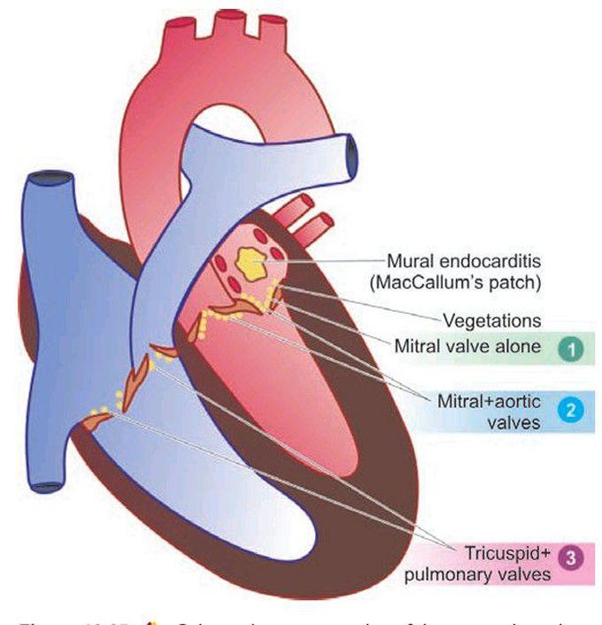 Vegetations in rheumatic endocarditis