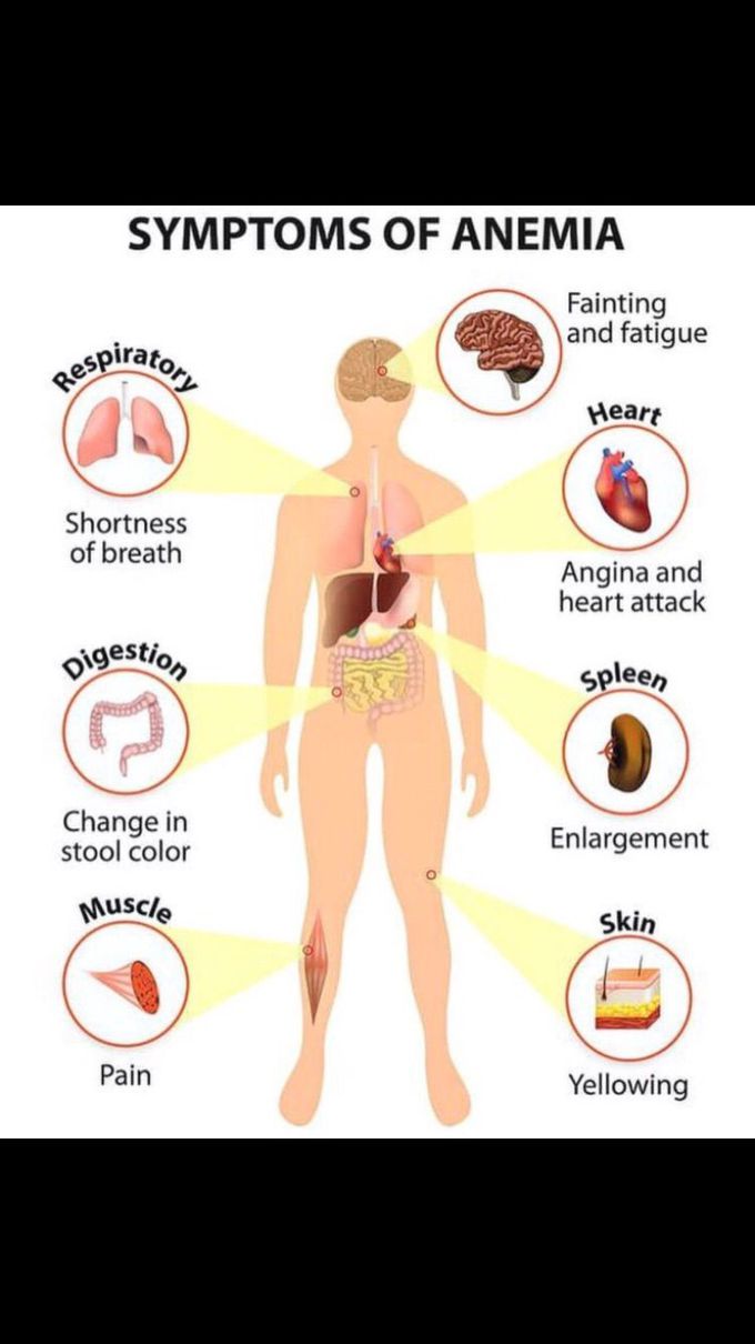 Anemia