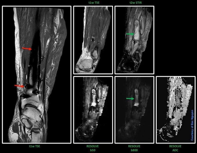 Intramedullary rod in the tibia along with some screws (red arrows)