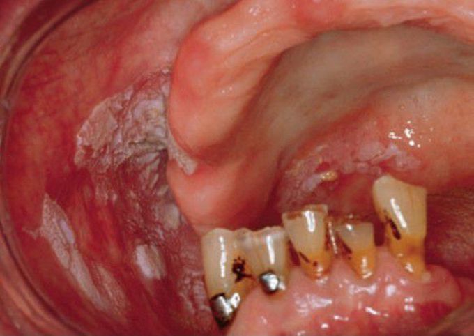 Proliferative verrucous leukoplakia