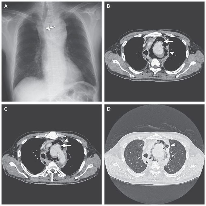 Salmonella enterica Aortitis
