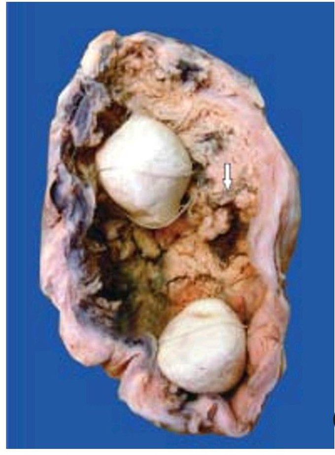 Carcinoma gallbladder.