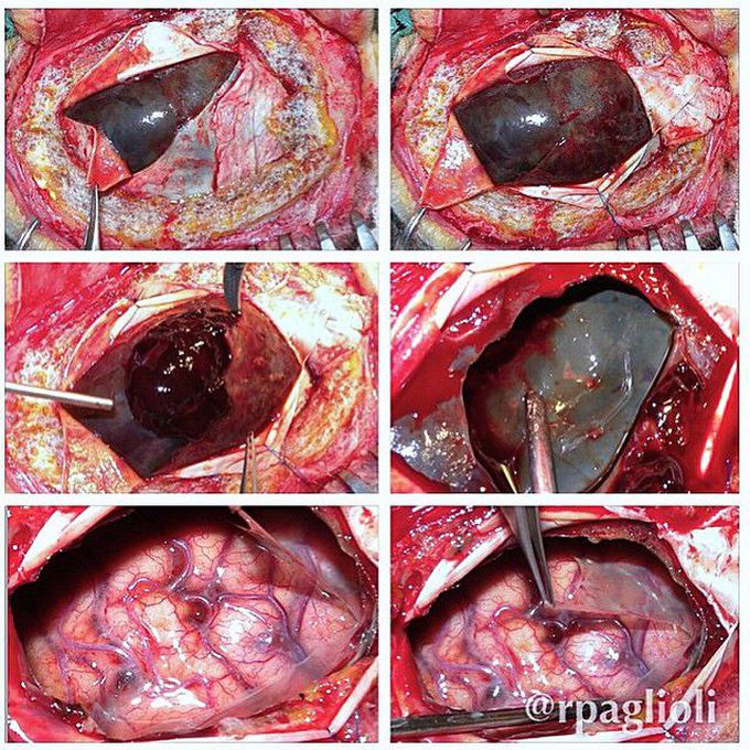 Chronic subdural hematoma surgery