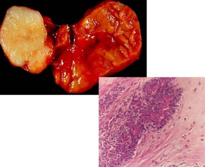 Parotid Gland Malignancy