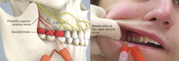 Posterior superior alveolar nerve block