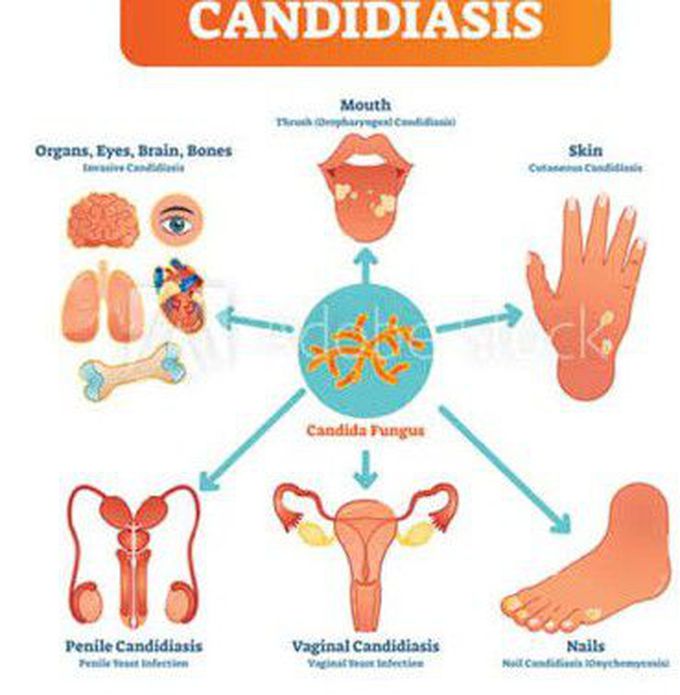 Causes of candidiasis
