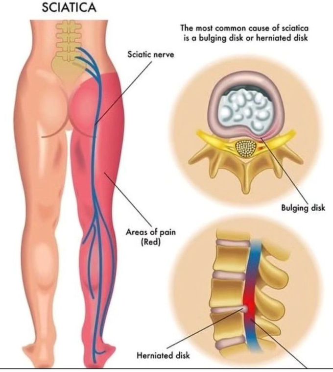 Sciatica