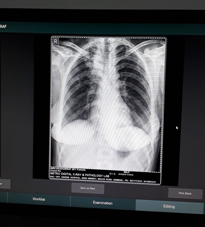 Chest xray PA view