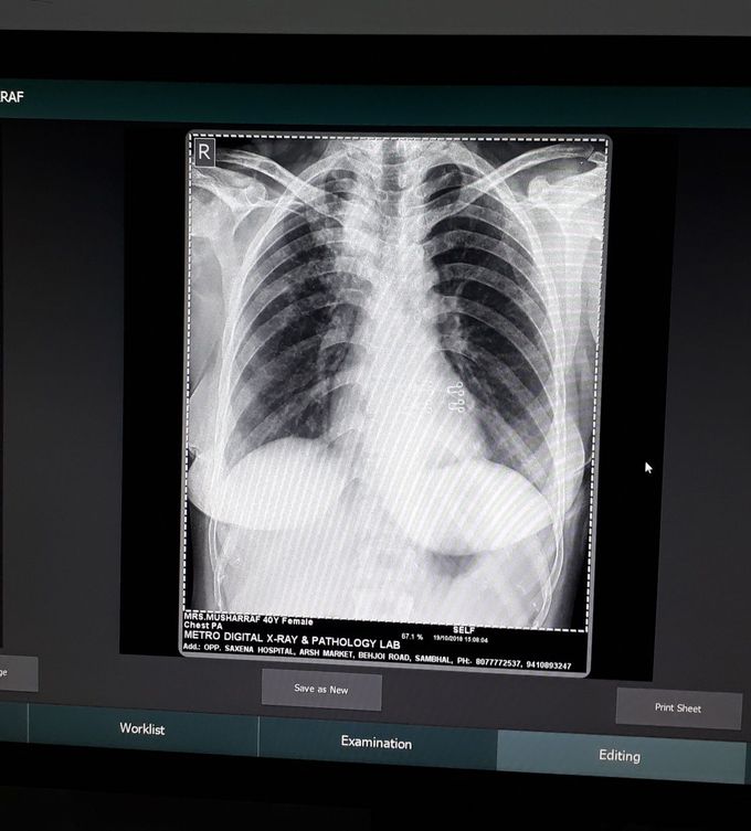 Chest xray PA view - MEDizzy