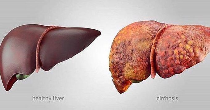Healthy Liver vs Cirrhotic Liver