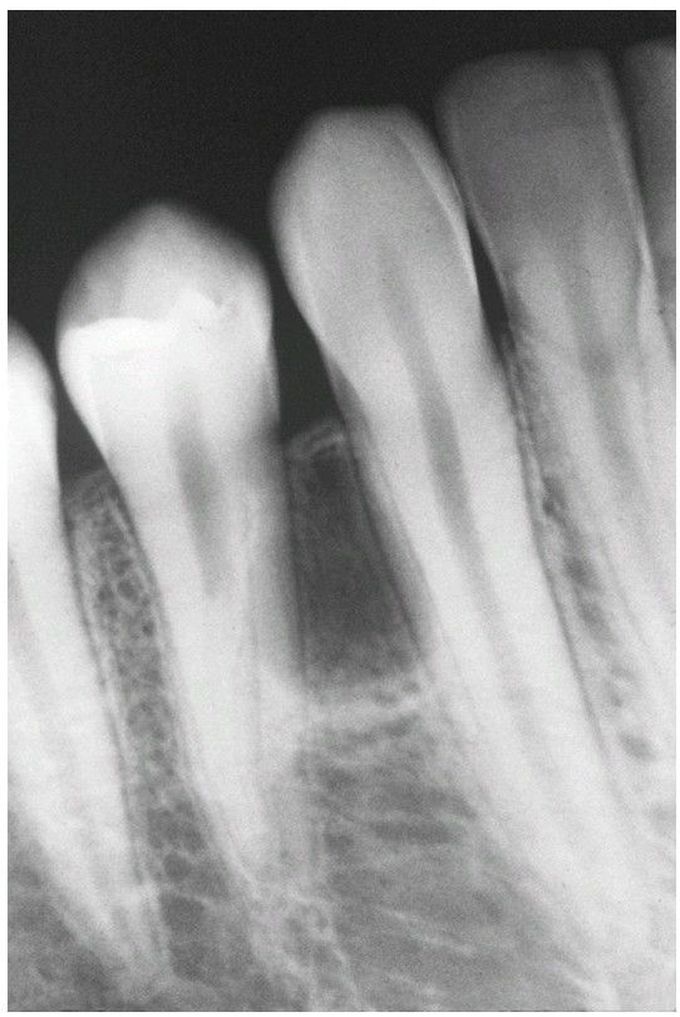 Lateral Periodontal Cyst.