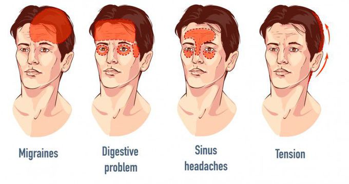 Causes of Headaches