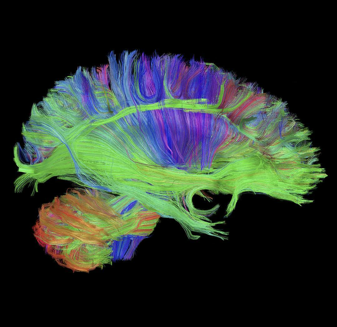 MRI with diffusion tractography