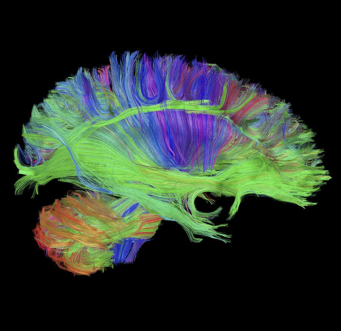 MRI with diffusion tractography - MEDizzy