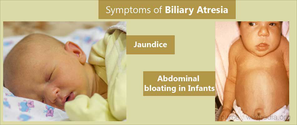 Symptoms Of Biliary Atresia - MEDizzy