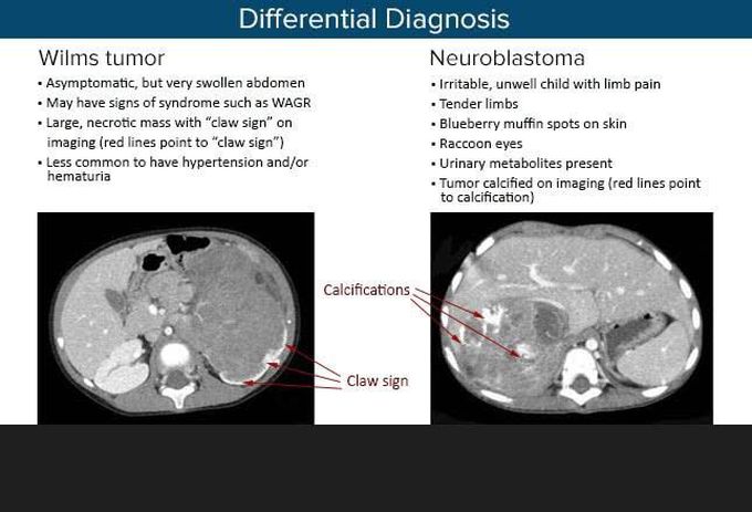 Wilms Tumor and Neuroblastoma