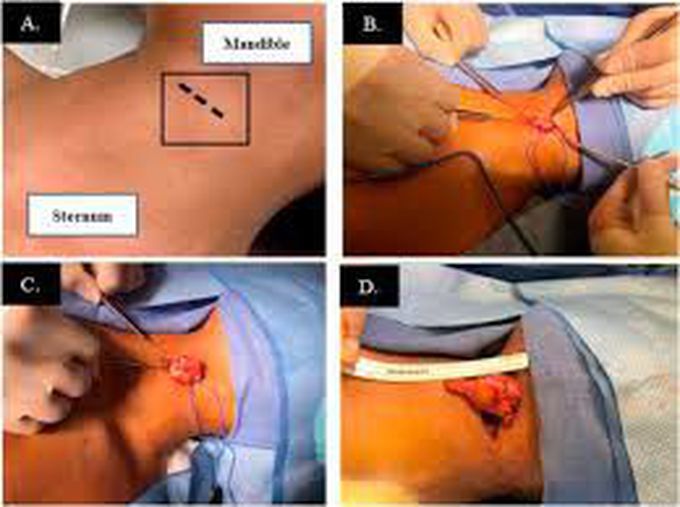 Thymic cyst treatment