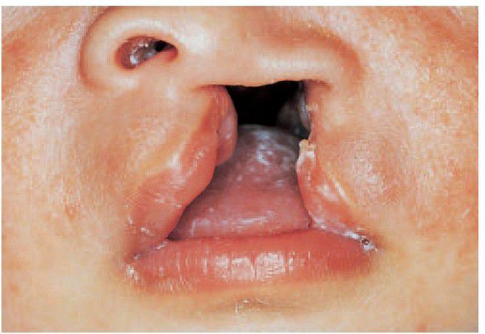 Cleft lip and palate.