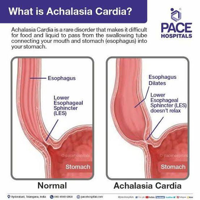 Complications of achalasia