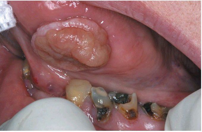 Traumatic Granuloma.