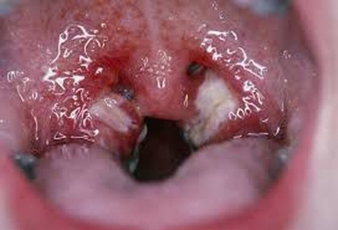 Glandular fever