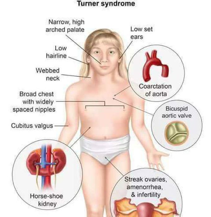 Turner Syndrome