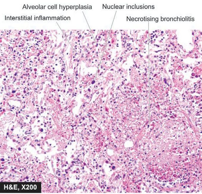 Interstitial pneumonitis (viral pneumonia).