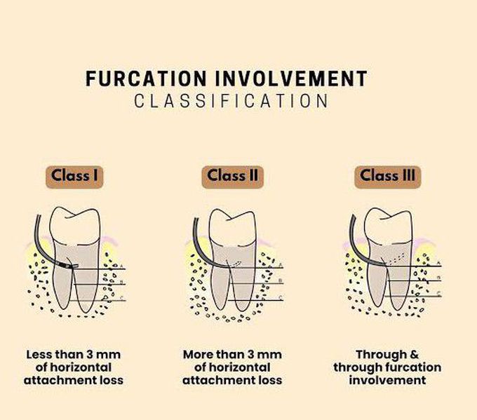 Furcation Involvement Classification