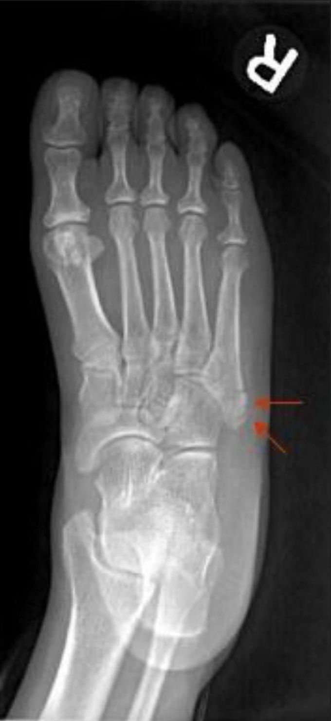 Zone 1
(pseudo Jones fx)

▪️Proximal tubercle (rarely enters 5th tarsometatarsal joint)
▪️Due to long plantar ligament, lateral band of the plantar fascia, or contraction of the peroneus brevis
▪️Nonunions uncommon