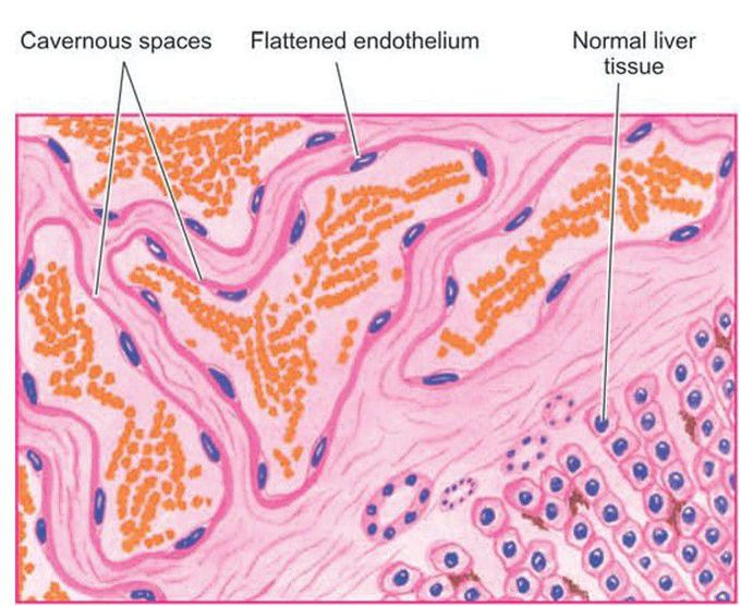 Cavernous haemangioma