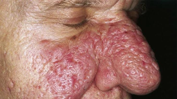 Symptoms of rhinophyma