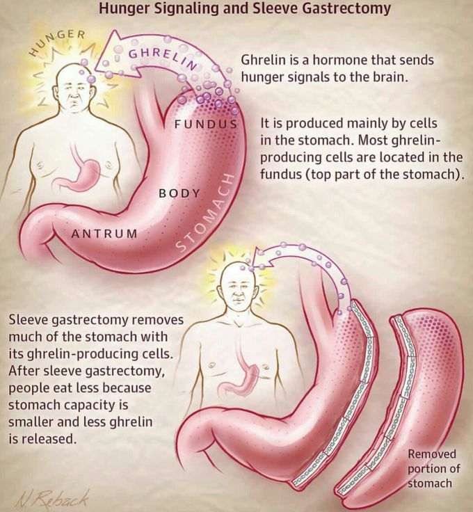 Sleeve Gastrectomy