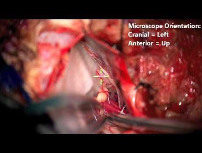Retrosigmoid approach for resection of an extraventricular choroid plexus papilloma