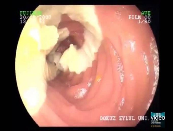 Taenia saginata in the Small Intestine