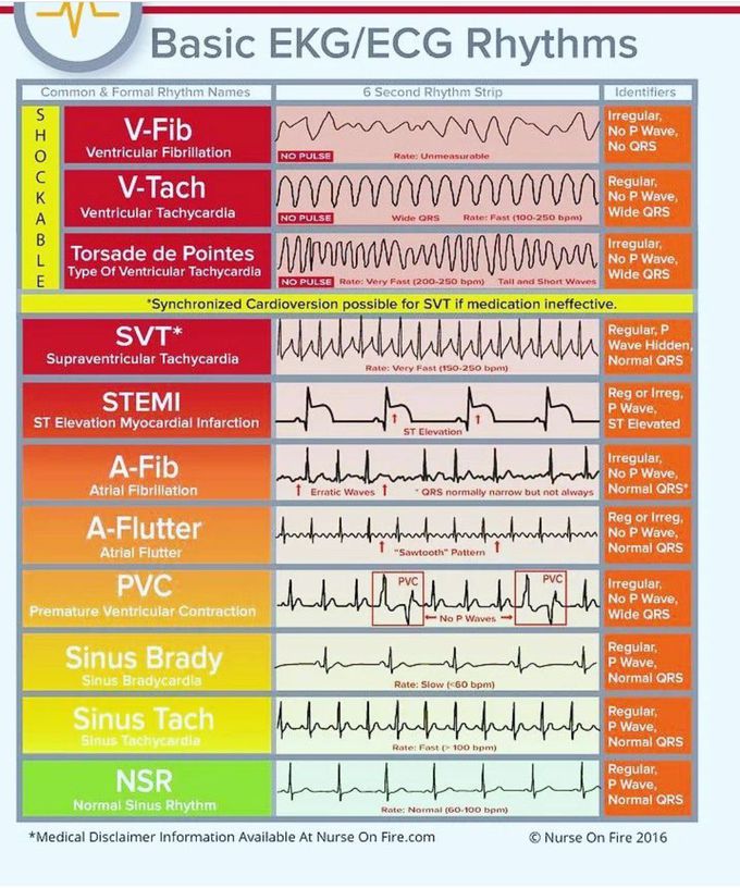 Basic ECG Rhythms