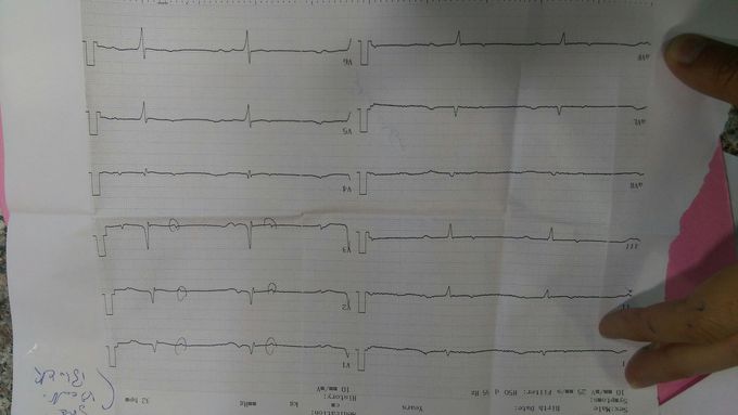 3rd degree heart block