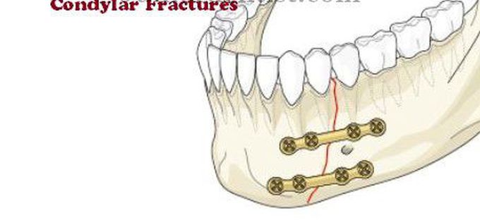 Cause of Condylar fracture