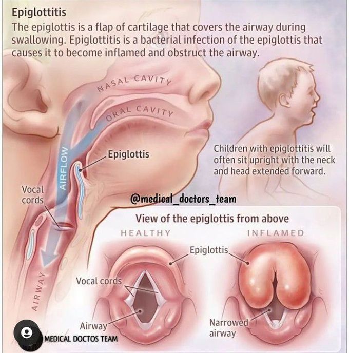 Epiglottitis