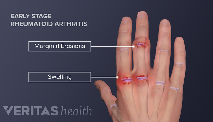 Treatment of rheumayoid arthritis