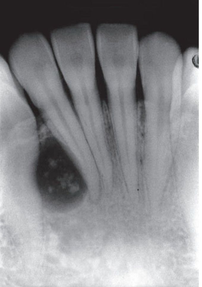 Adenomatoid odontogenic tumor