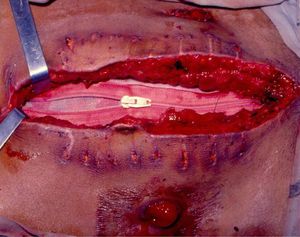 Temporary abdominal closure with nylon-mesh zipper device - MEDizzy
