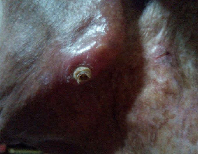 Skin Abscess (jaw)