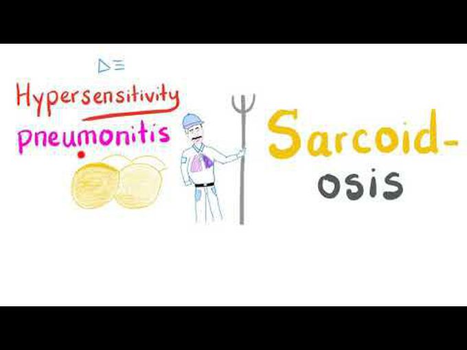 Hypersensitivity Pneumonitis VS Sarcoidosis | Pulmonary Medicine