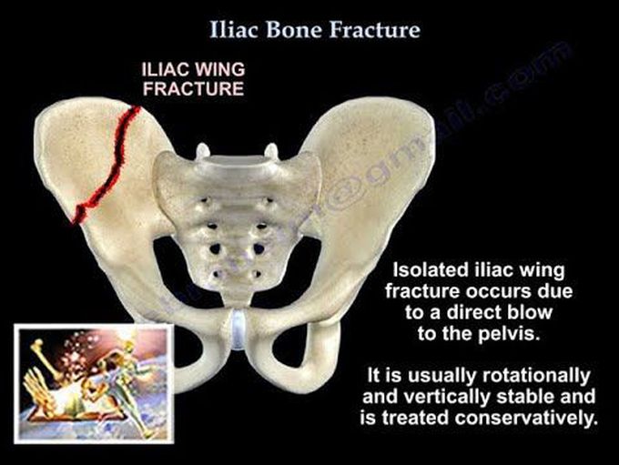 Iliac Bone Fracture - Everything You Need To Know - Dr. Nabil Ebraheim