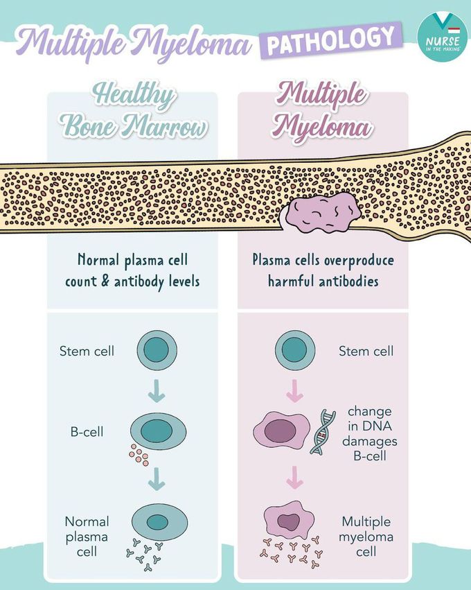 Multiple Myeloma