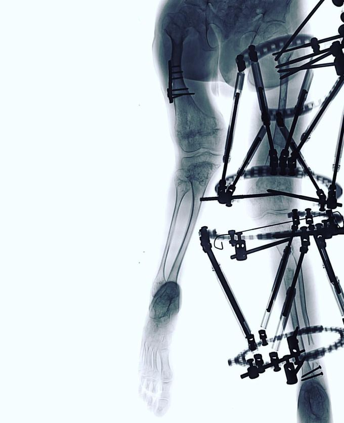 Leg Lengthening X-ray