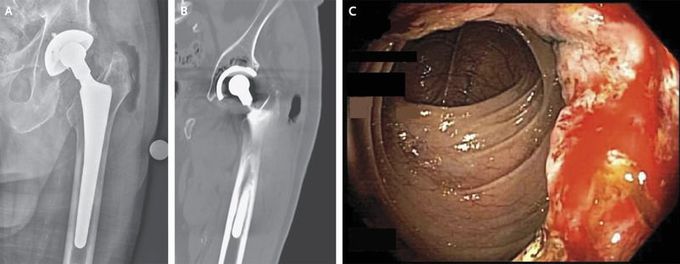 Gas Gangrene of a Prosthetic Hip