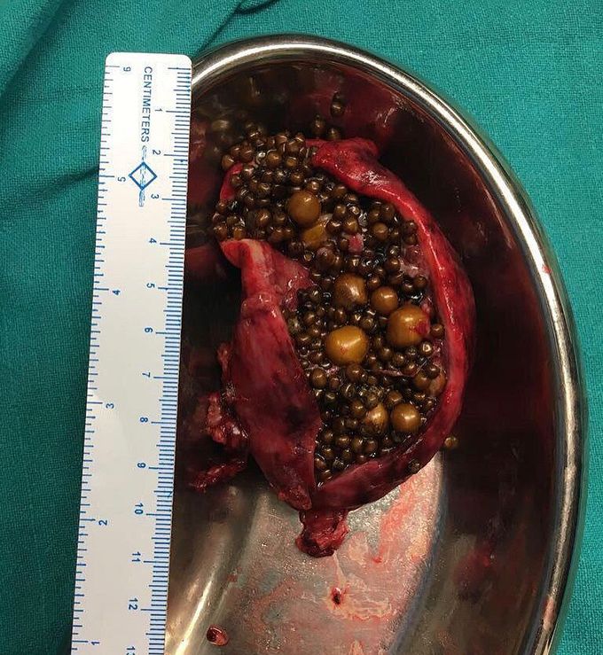 Gallstones