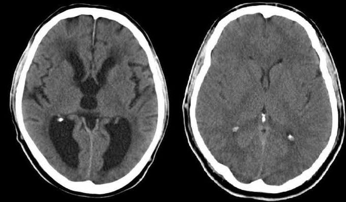 Symptoms of pseudotumor cerebri